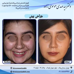 جراحی بینی - دکتر موسوی زاده