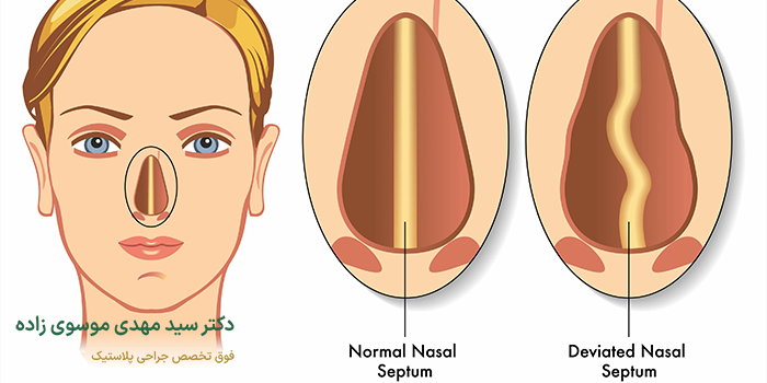 جراحی انحراف بینی
