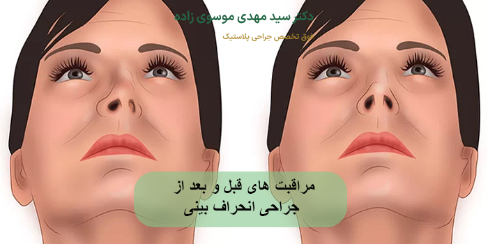 مراقبت‌ های قبل و بعد از جراحی انحراف بینی