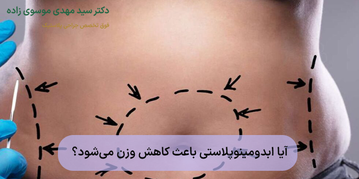 آیا ابدومینوپلاستی باعث کاهش وزن میشود؟
