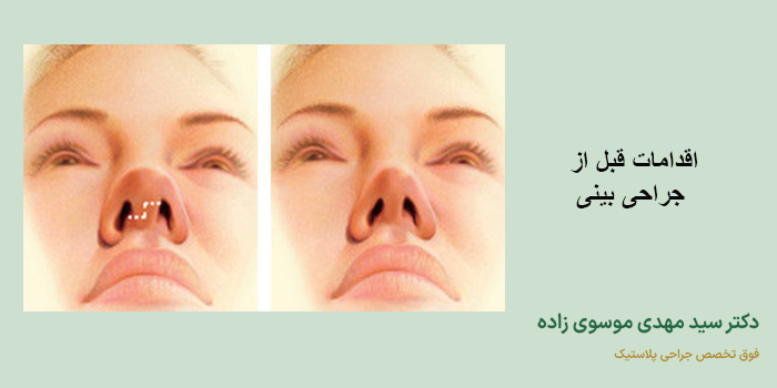 اقدامات قبل از جراحی بینی