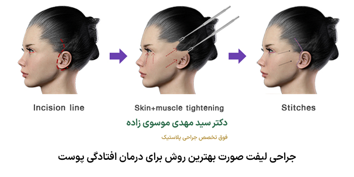بهترین روش برای درمان افتادگی پوست