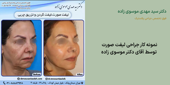 نتایج جراحی لیفت صورت