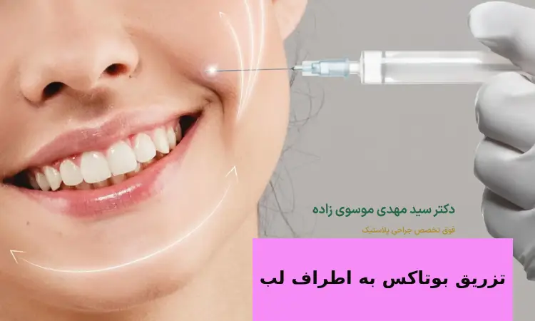تزریق بوتاکس اطراف لب چیست؟