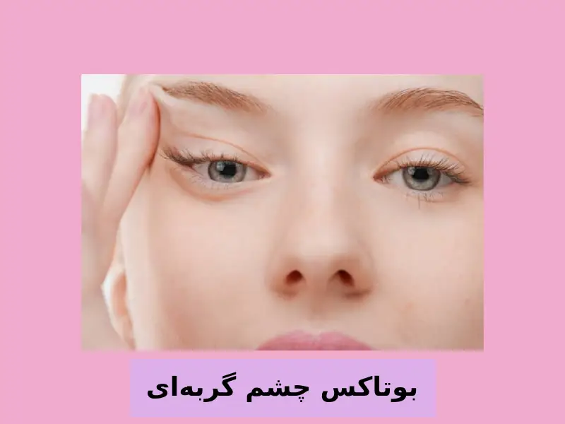 بوتاکس چشم گربه‌ای