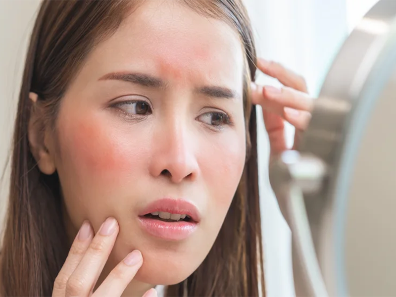 آلرژی و حساسیت به بوتاکس