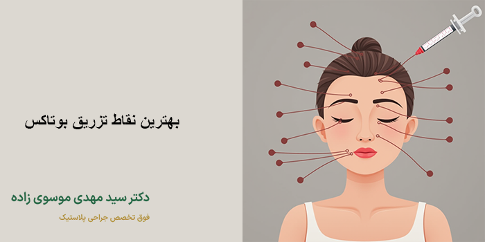 نقاط مناسب تزریق بوتاکس برای میگرن