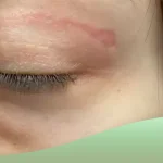جای بخیه بعد از بلفاروپلاستی