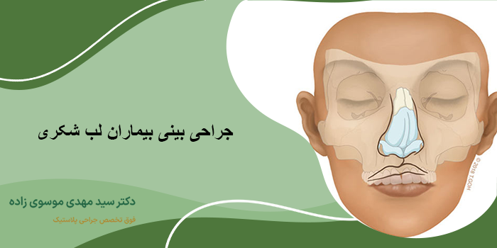 جراحی بینی بیماران لب شکری