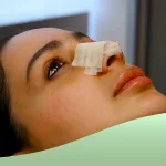 چسب زدن بینی بعد از عمل