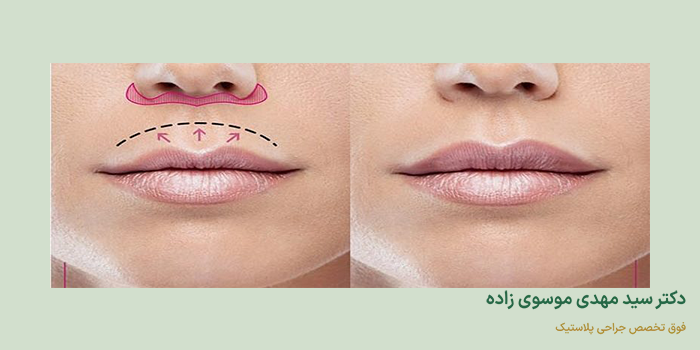 درمان بی حسی لب پس از عمل بینی