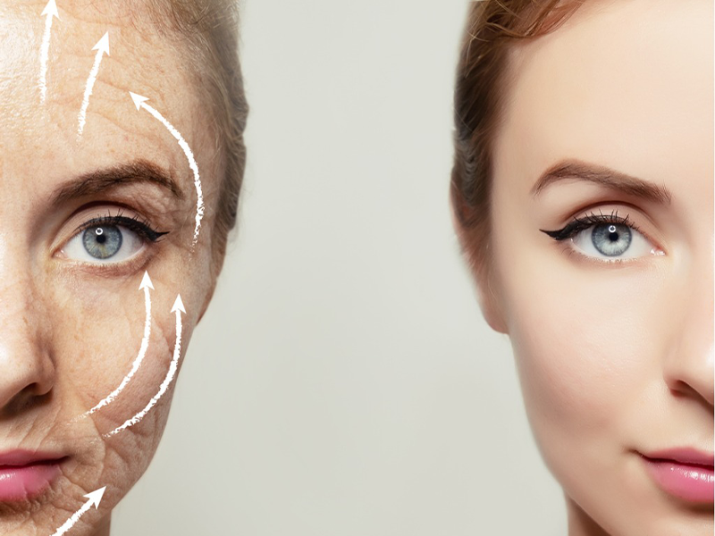 لیفت شقیقه با بوتاکس