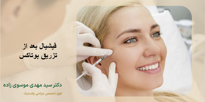 فیشیال بعد از بوتاکس
