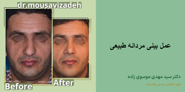 عمل بینی مردانه