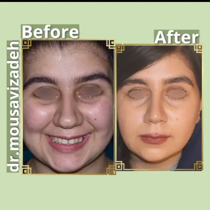 جراحی بینی گوشتی