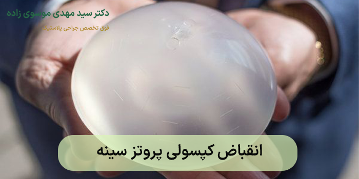 انقباض کپسولی پروتز سینه